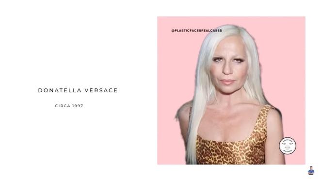 Donatella Versace  przed operacjami 