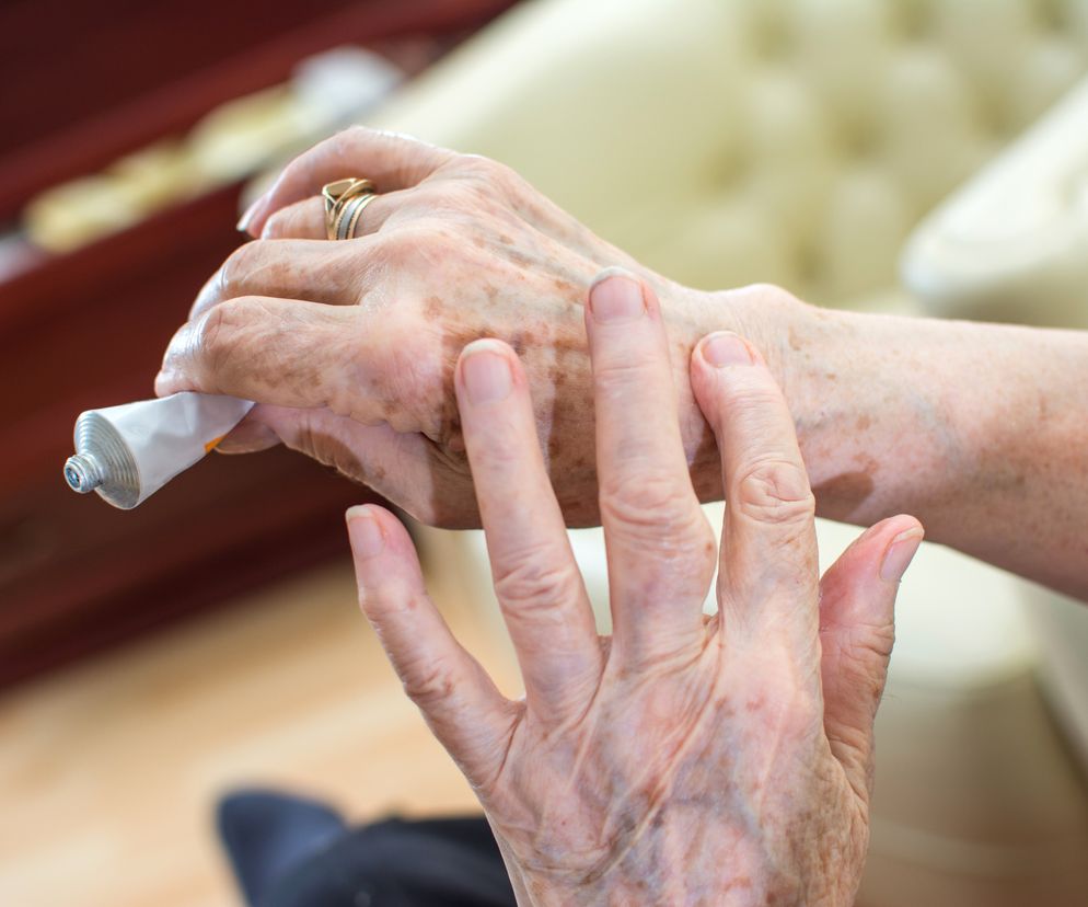 Przebarwienia u seniora - jak się ich pozbyć?