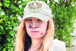 Przeszła 350 operacji