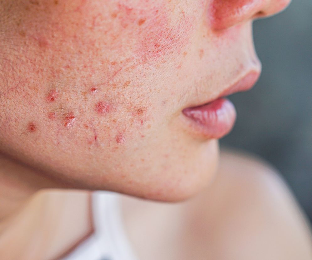 zbliżenie na skórę kobiety pokrytą trądzikiem hormonalnym