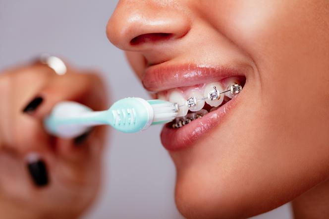 Jak dbać o higienę jamy ustnej z aparatem ortodontycznym?