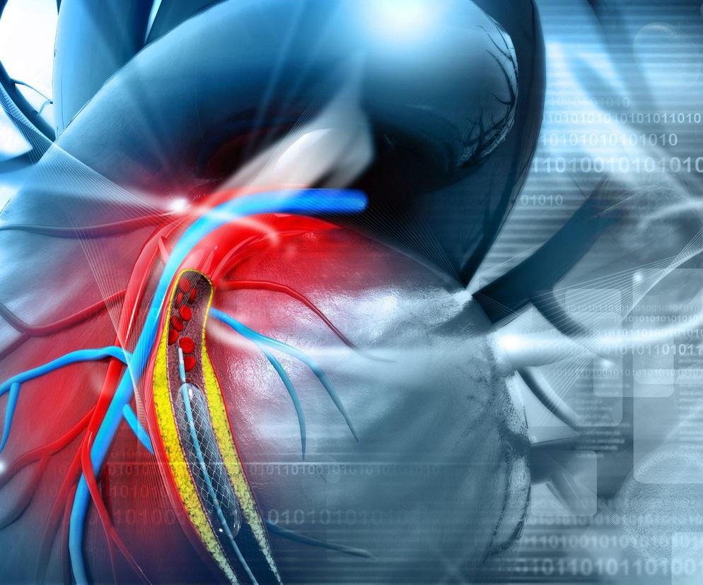 Lublin - pierwsze operacje implantacji stengraftu w łuku aorty