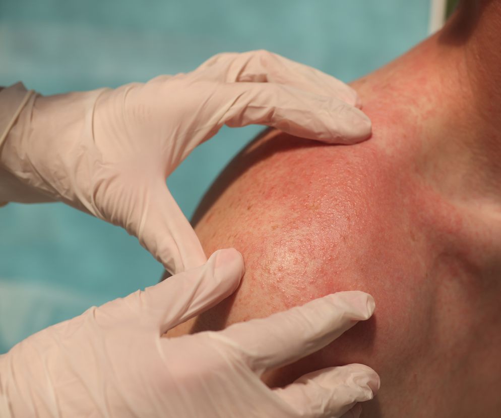 Pięć nietypowych objawów chorej trzustki, które widać na skórze. Nie lekceważ ich