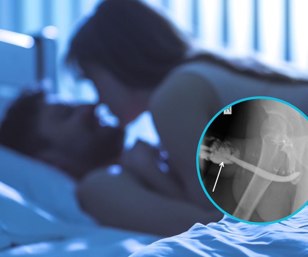 Niezwykle rzadki, nagły wypadek. Podczas seksu złamał penisa w trzech miejscach