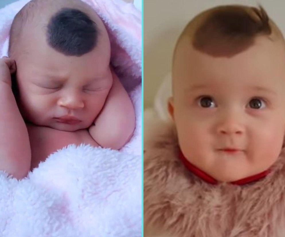 Przyszła na świat z „rogiem jednorożca”. To przypadek raz na 50 tys. urodzeń