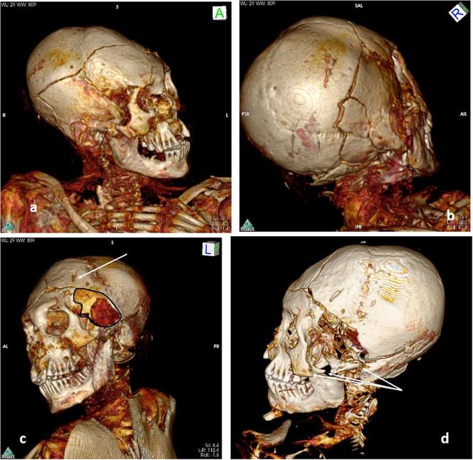 Prześwietlenie mumii z Marburga pokazujące ślady po uderzeniu 