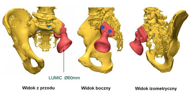 A tak ze wszczepioną protezą