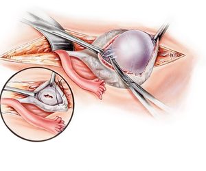 Torbiel skórzasta jajnika: przyczyny, objawy, leczenie