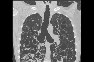 Zabrze: Drugą taką operację na świecie wykonano na Śląsku!