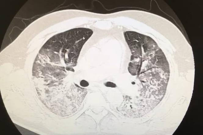 Lekarz pokazał tomografię płuc 44-latka z COVID