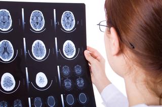 Tomografia komputerowa (TK, CT) głowy - badanie RTG mózgu