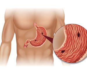 HELICOBACTER PYLORI: bakteria, która może doprowadzić do RAKA  