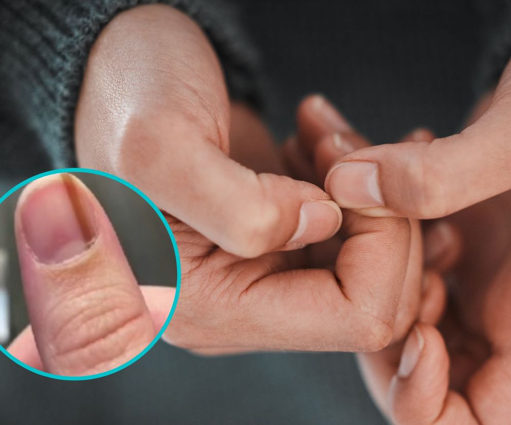 Czarna smuga na paznokciu była objawem raka. Lekarze kazali tylko obserwować