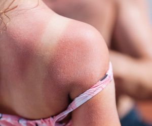 Wstrząs i sepsa po opalaniu? Reguła dłoni pomaga ocenić, kto jest zagrożony