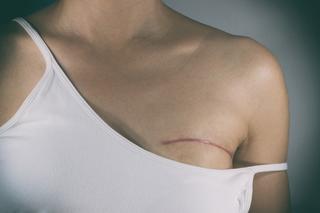Zalecenia po mastektomii - co robić po zabiegu usunięcia piersi?