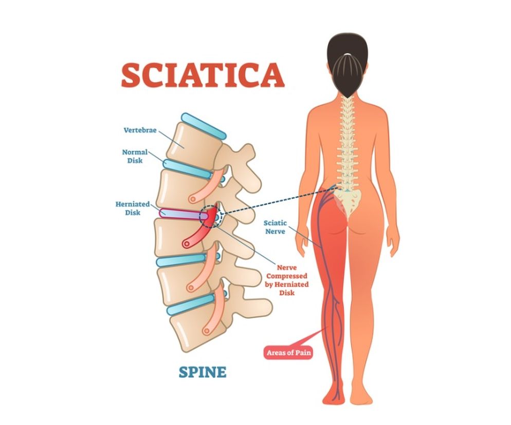 Rwa udowa to zwykle ból w odcinku lędźwiowym kręgosłupa promieniujący do przedniej części uda, ale także do pośladków i łydki.