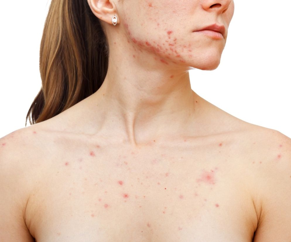 Zbliżenie na twarzy młodej kobiety - widoczne zmiany skrórne m.in. trądzik. 