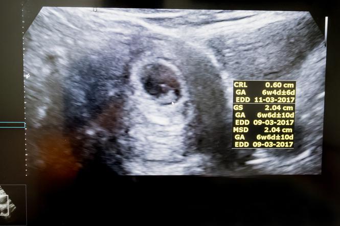 Kiedy na USG widać pęcherzyk ciążowy, a kiedy widać zarodek? 