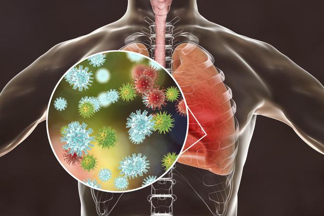 Zapalenie płuc: przyczyny, rodzaje, objawy i powikłania