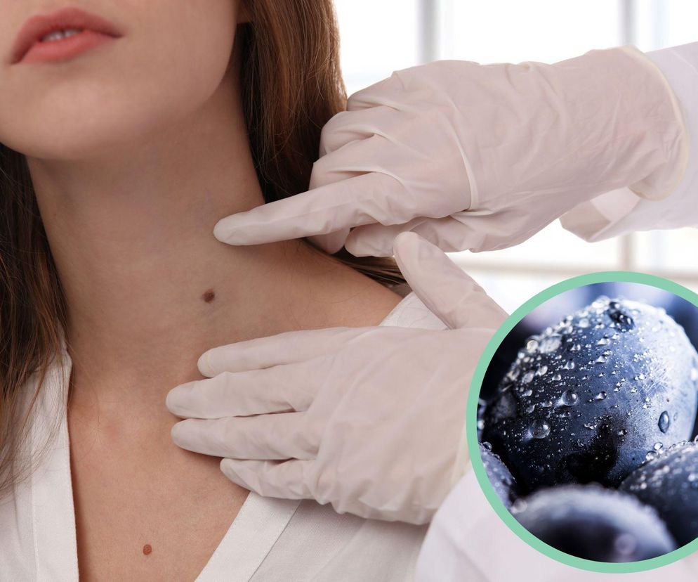 Te owoce mogą zapobiec czerniakowi? Chronią skórę przed promieniowaniem UV