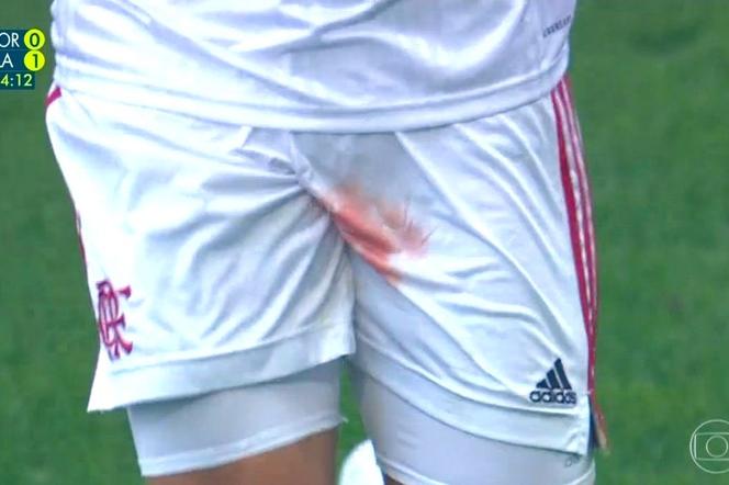 Krocze piłkarza zalało się krwią podczas meczu! Boli od samego patrzenia [ZDJĘCIA]