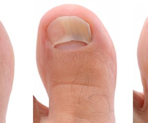 Leczenie grzybicy paznokci. Czy można leczyć grzybicę paznokci w domu?