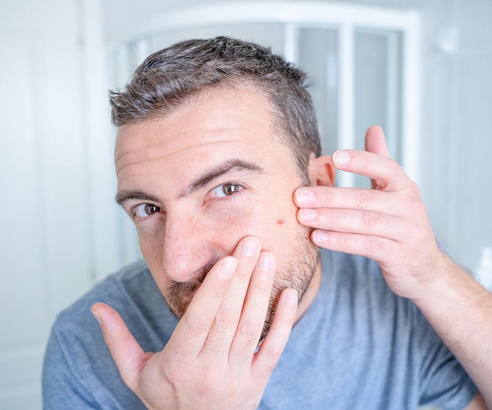 Ropnie mnogie - przyczyny, objawy i leczenie