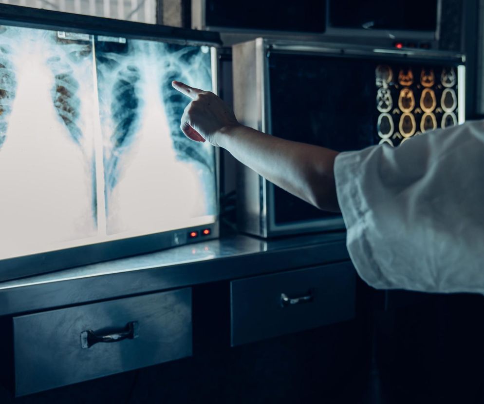 Rak płuca nie odpuszcza. Mimo spadku palenia choruje coraz więcej Polaków