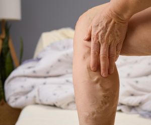 Zaczyna się od pajączków, kończy zakrzepicą. Nowe dane pokazują, jak groźne są żylaki