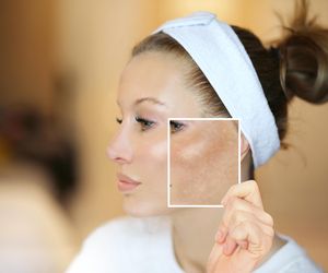 Leczenie przebarwień to połowa sukcesu. Sprawdź, jak utrzymać efekt 