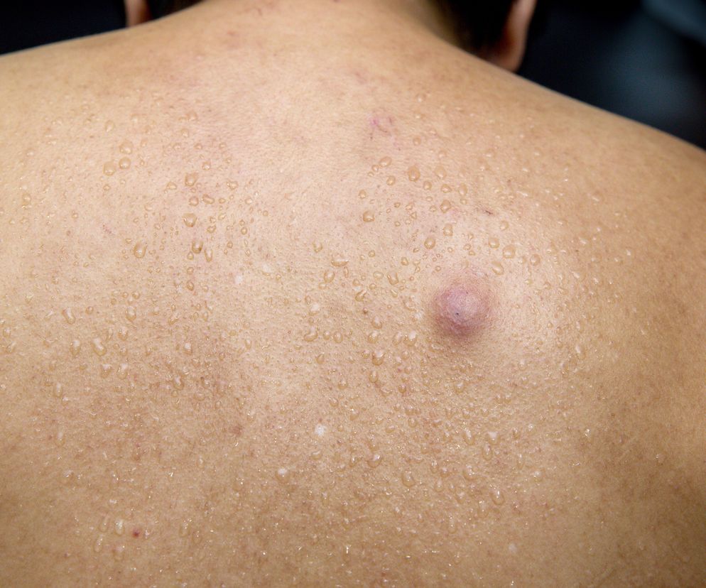 Czyrak to wrzód o podłożu bakteryjnym