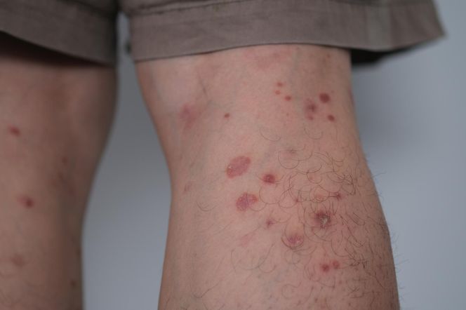 Objaw u 42-latka wydawał się niegroźny. Teraz zostało mu kilka miesięcy życia
