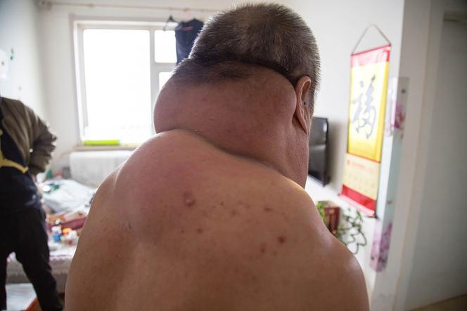 Mężczyzna z wielką szyją