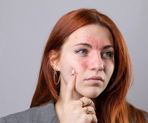 Jedna z najbardziej podstępnych chorób. 10 maja obchodzimy Światowy Dzień Tocznia