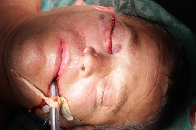 Wydrukowali mu nowe kości twarzy