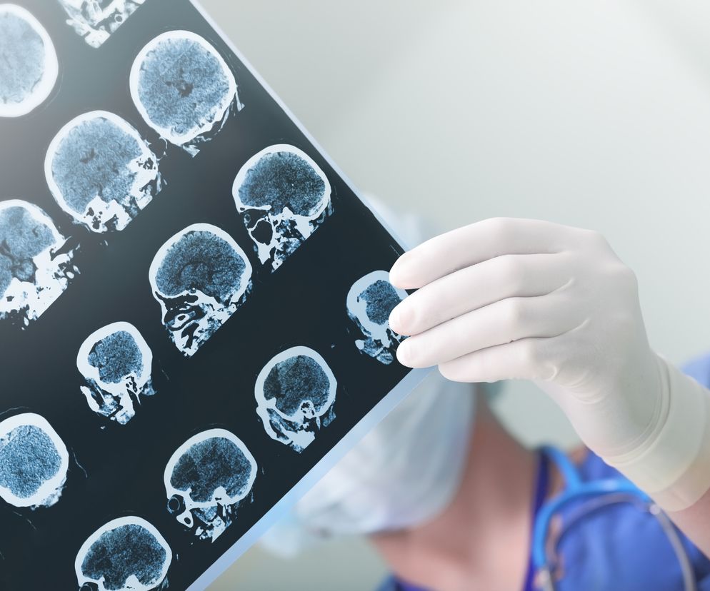 Udar móżdżku daje bardzo nietypowe objawy. Dowiedz się, jak go rozpoznać