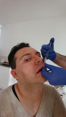 Michał Witkowski wstrzykuje sobie botoks i powiększa usta!