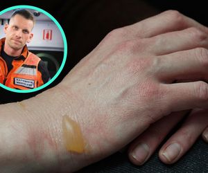 Nie przebijaj pęcherzy, wyrzuć maślankę. Ratownik ma lepszy sposób na oparzenia