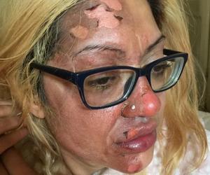 Niebezpieczny trend z TikToka. Kobieta poparzyła pół twarzy