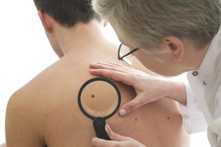 Znamiona: po wakacjach skontroluj pieprzyki i  zmiany na skórze u dermatologa