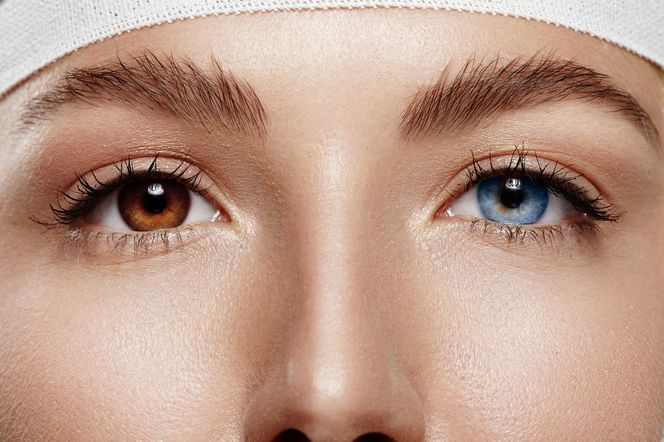 Heterochromia