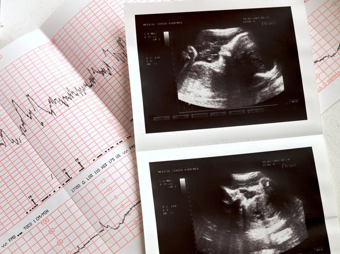 Czy w świetle nowych przepisów wykonywanie badań prenatalnych będzie jeszcze miało sens?