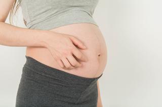 Wysypka w ciąży - skąd się biorą krostki na ciele i jakie są rodzaje wysypek w ciąży