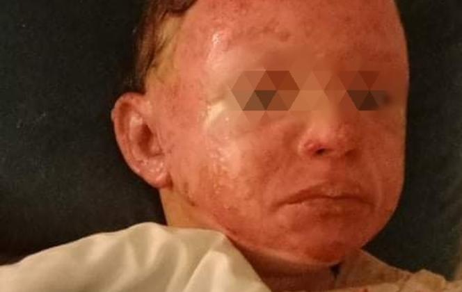Dramat rodziny po wybuchu gazu. Ciężko poparzone dzieci. " Łzy na naszych policzkach płyną nieustannie" [DRASTYCZNE ZDJĘCIA]