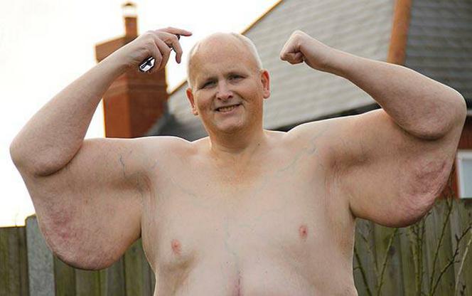 Najgrubszy człowiek świata schudł 300 kilogramów 