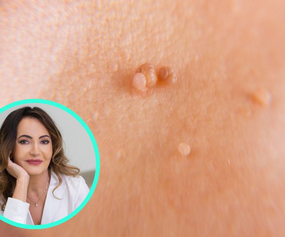 Szpecą, ale nie są groźne. Na pewno odróżnisz włókniaki od groźnego nowotworu?