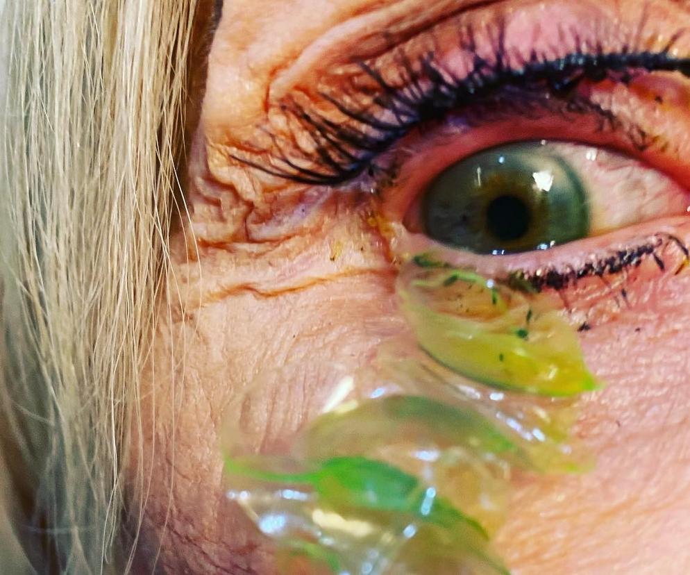 Soczewki kontaktowe w oczodole 