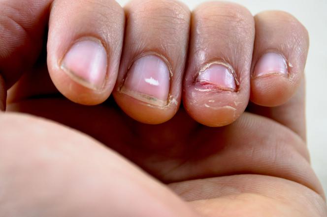 obgryzanie paznokci przyczyny co robic zeby dziecko przestalo obgryzac paznokcie mjakmama pl sally hansen do usuwania skorek zestaw lakierow