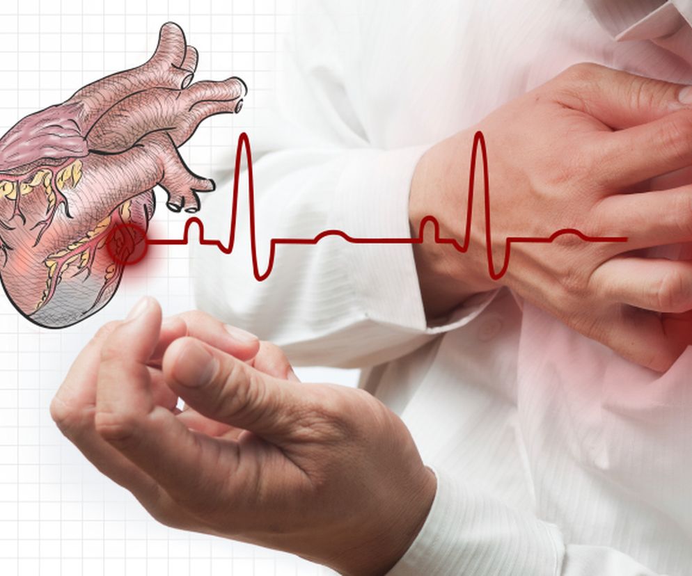 Zespół Brugadów to uwarunkowana genetycznie skłonność do arytmii pochodzenia komorowego.