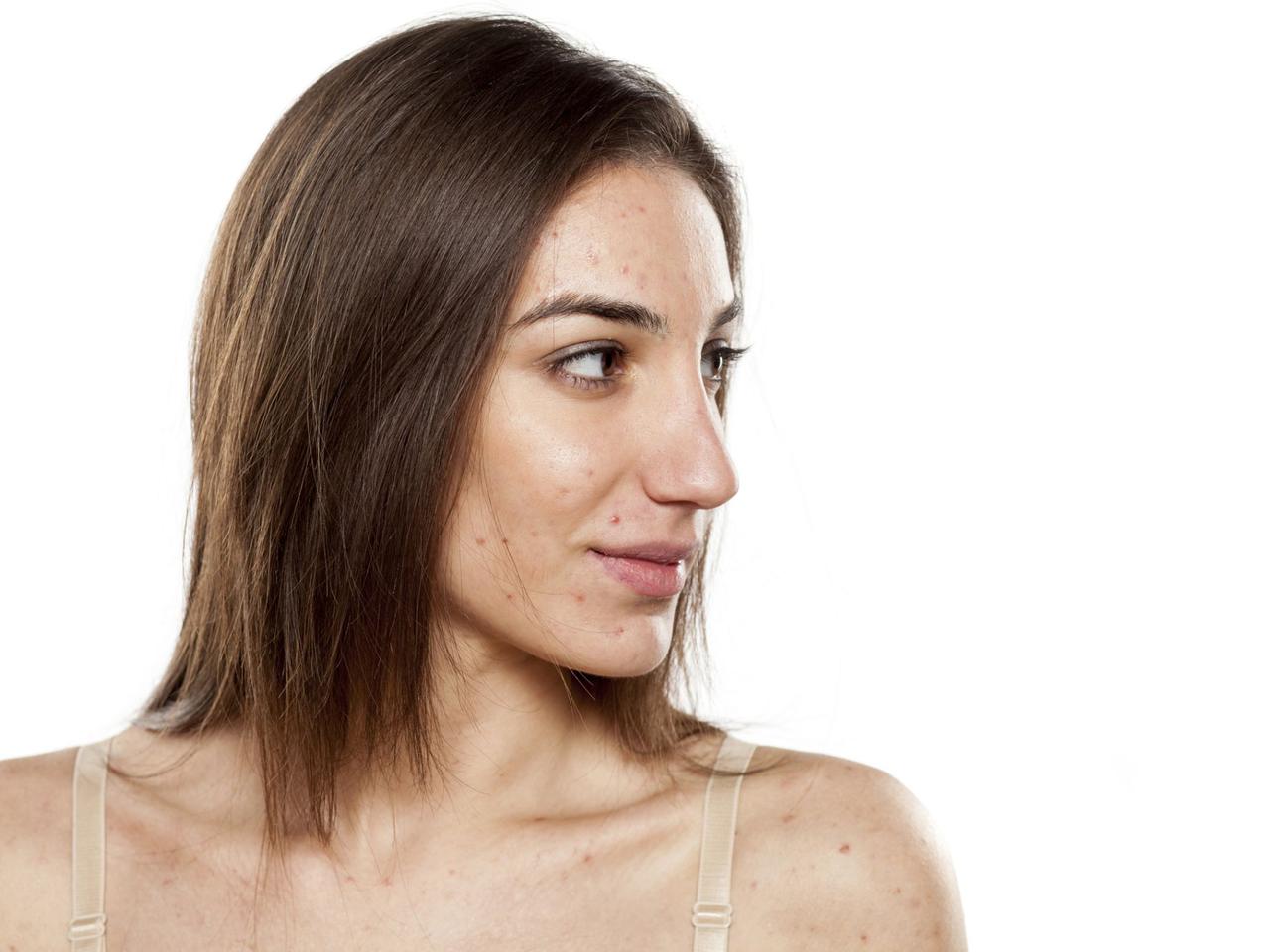 Trądzik: objawy i skuteczne leczenie